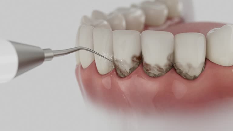 Trusted Wisdom Tooth Removal service in Lucas, TX - Dentist Open Now